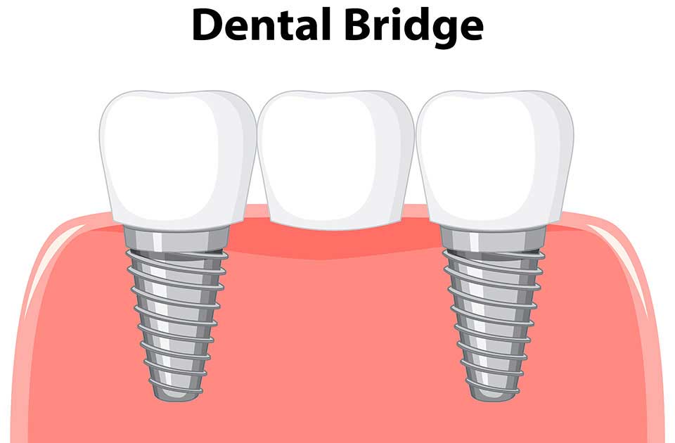 بریج دندان چیست ؟