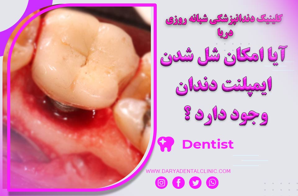 آیا امکان شل شدن ایمپلنت دندان وجود دارد؟