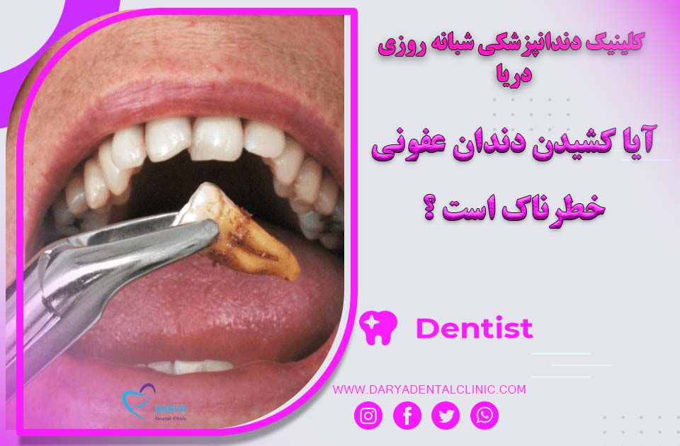 آیا کشیدن دندان عفونی می تواند خطرناک باشد ؟