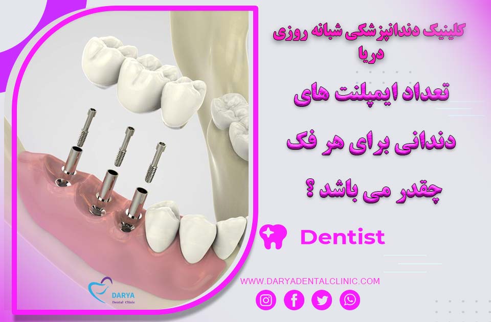 تعداد ایمپلنت‌های دندانی برای هر فک چقدر است ؟