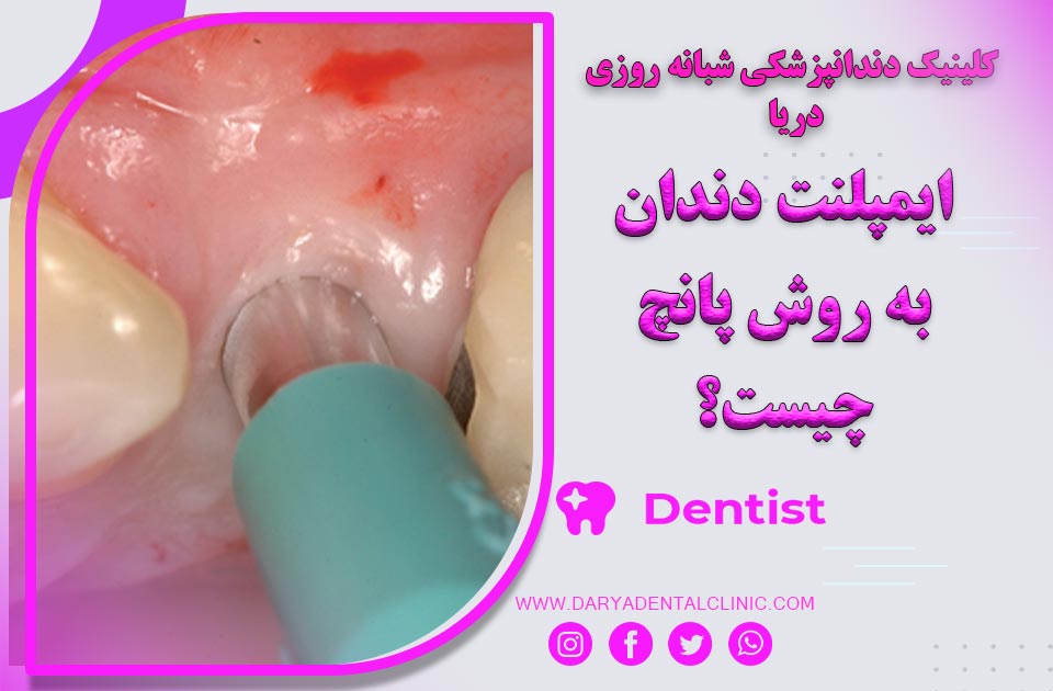 ایمپلنت دندان به روش پانچ چیست ؟ ( روشی مدرن )