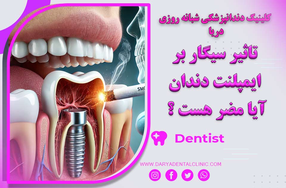 تأثیر سیگار بر ایمپلنت دندان ، آیا مضر هست ؟