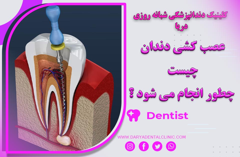 عصب کشی دندان چیست و چطور انجام می شود ؟