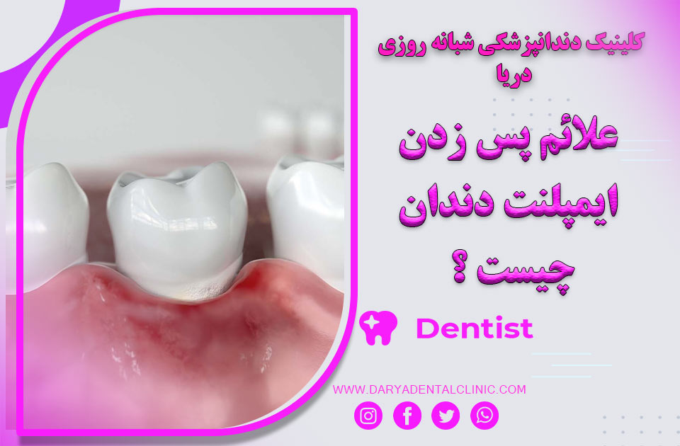 علائم پس زدن ایمپلنت دندان چیست ؟