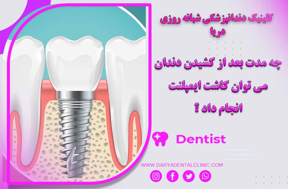 چه مدت بعد از کشیدن دندان می توان کاشت ایمپلنت را انجام داد ؟