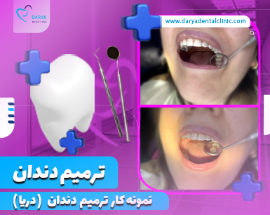 نمونه کار ترمیم دندان در دندانپزشکی دریا کرج