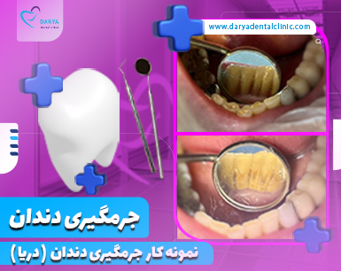 نمونه کار جرم گیری دندان در دندانپزشکی دریا