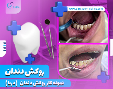 نمونه کار روکش دندان در دندانپزشکی شبانه روزی دریا