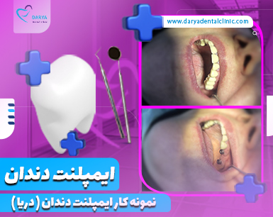 نمونه کار ایمپلنت دندان دندانپزشکی دریا