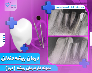 نمونه کار درمان ریشه دندان در دندانپزشکی دریا