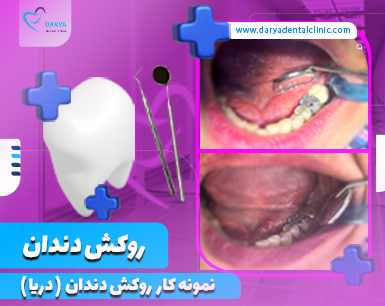 نمونه کار روکش دندان در دندانپزشکی دریا