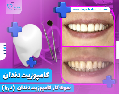 نمونه کار کامپوزیت دندان در دندانپزشکی دریا