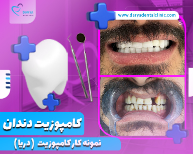 نمونه کار کامپوزیت دندان در کرج